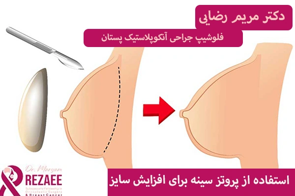 پروتز سینه برای افزایش سایز