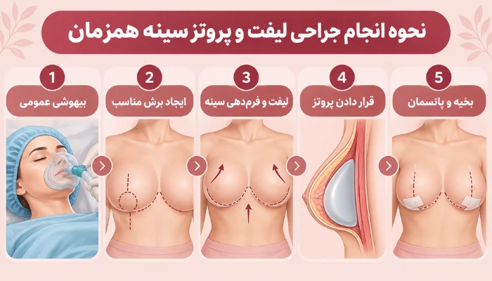 مراحل انجام جراحی لیفت و پروتز سینه همزمان شامل بیهوشی، ایجاد برش، فرمدهی سینه، قرار دادن پروتز و بخیه