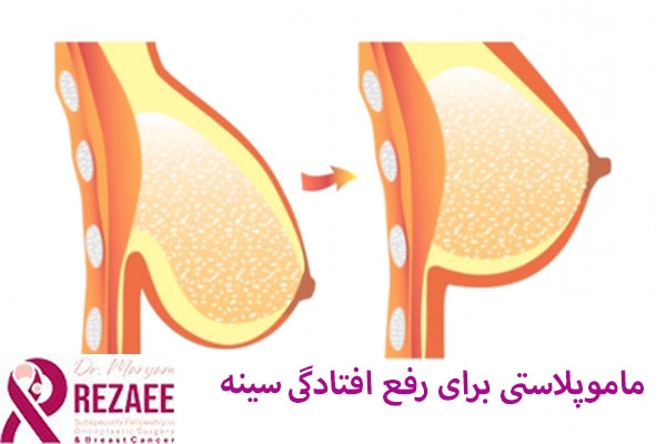 ماموپلاستی برای رفع افتادگی سینه