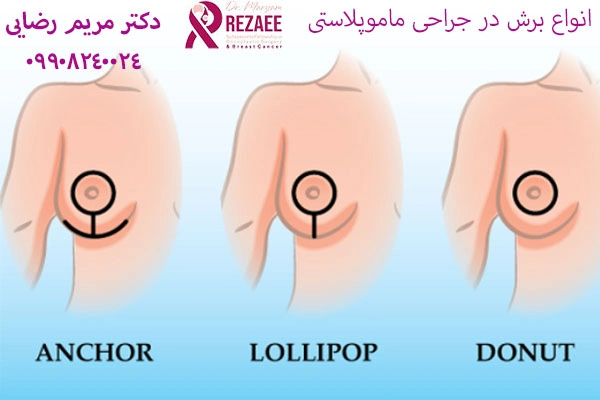 برش های ماموپلاستی