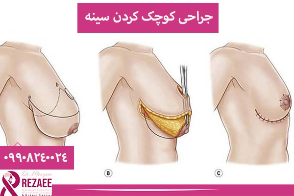 کوچک کردن سینه