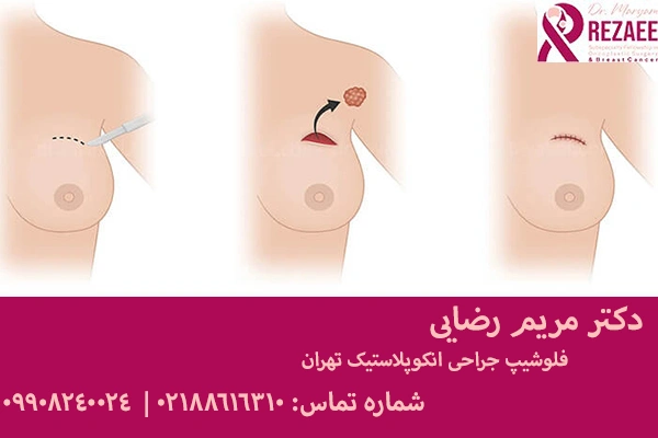 جراحی سرطان سینه