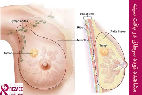 توده در بافت سینه