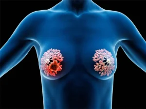 توده خوش خیم سینه