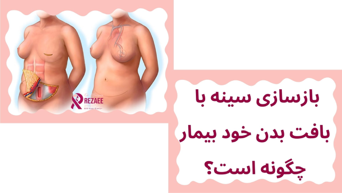 بازسازی سینه با بافت بدن