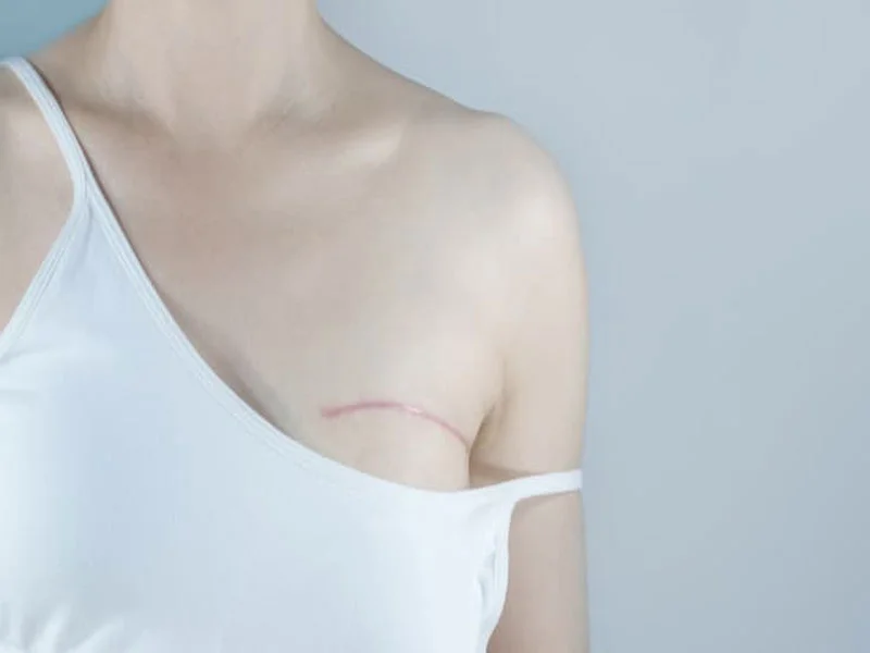 جراحی سرطان پستان