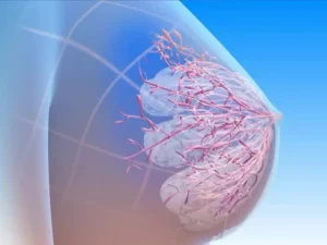 علائم سرطان سینه