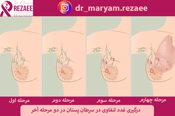 درگیری غدد لنفاوی در سرطان سینه