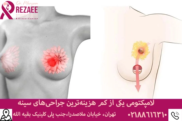 هزینه جراحی لامپکتومی سینه
