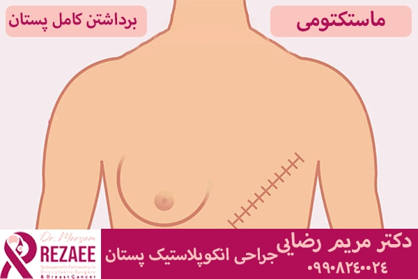 ماستکتومی