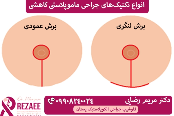 روش های ماموپلاستی کاهشی