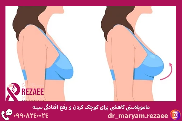 عمل کوچک کردن سینه