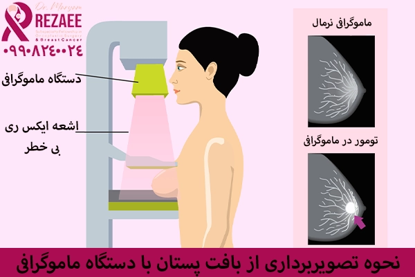 غربالگری سرطان سینه با ماموگرافی