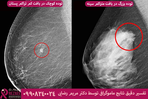 نتایج ماموگرافی