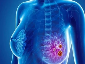 فیبروکیستیک پستان