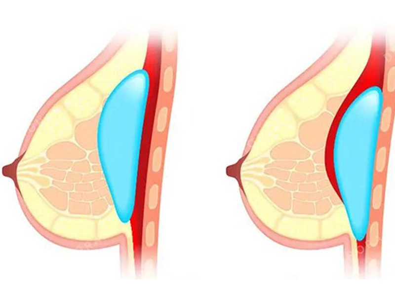 جابجایی پروتز سینه