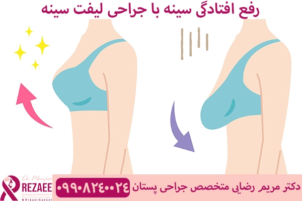 لیفت سینه