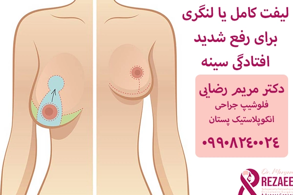 لیفت کامل سینه
