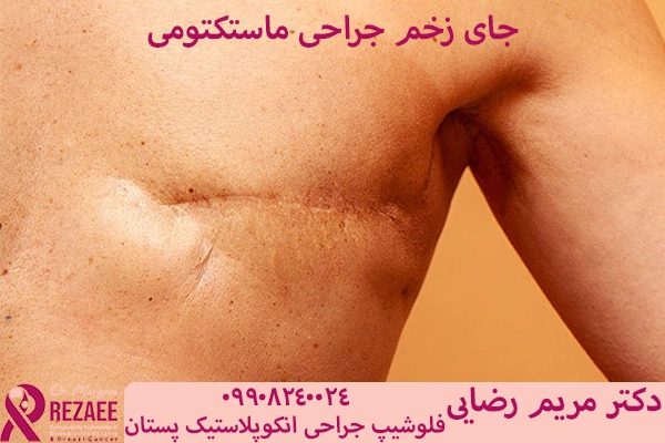 جای زخم و اسکار سرطان سینه