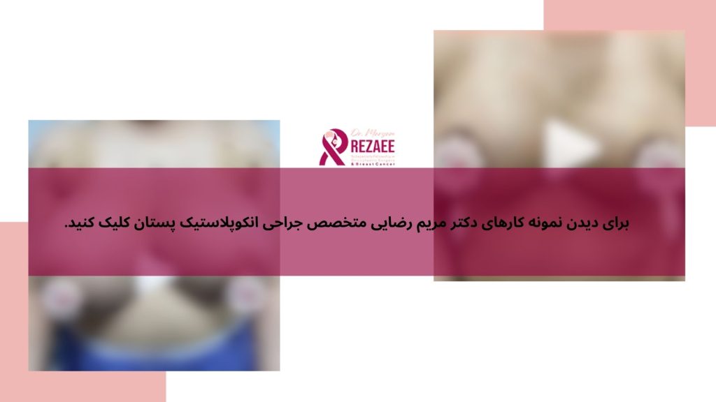 نمونه ماموپلاستی