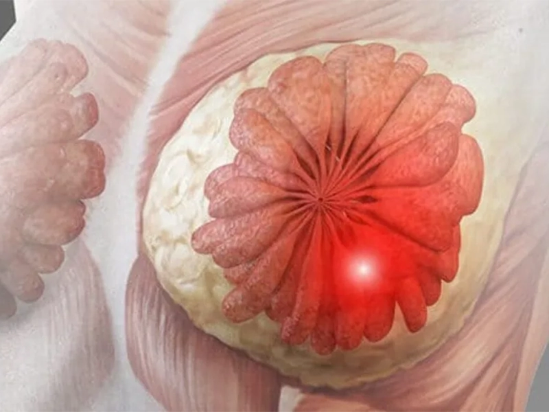 سرطان التهابی سینه