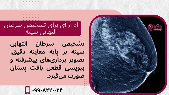 تشخیص سرطان التهابی پستان