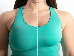 مزایای ماموپلاستی