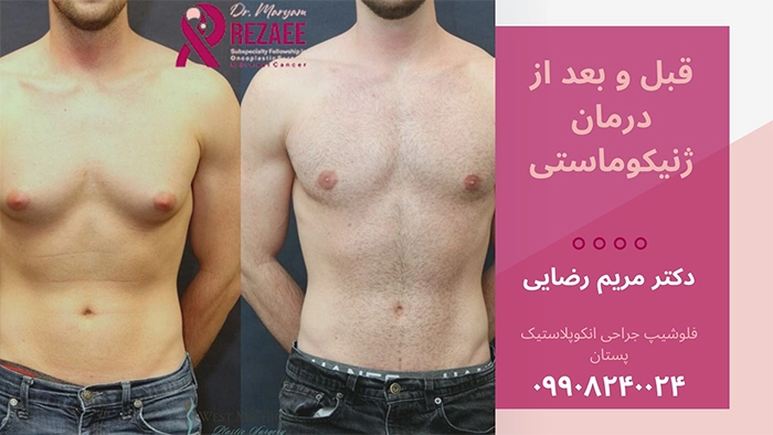 درمان ژنیکوماستی