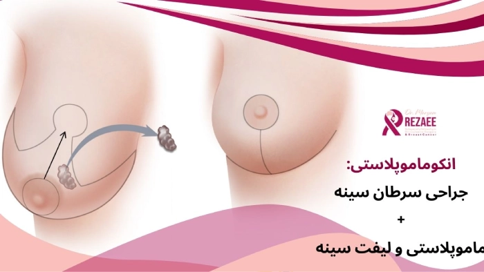 انکوماموپلاستی