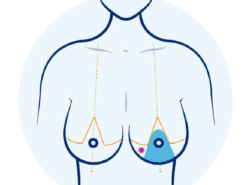 انکوماموپلاستی