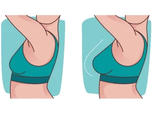 عکس قبل و بعد ماموپلاستی