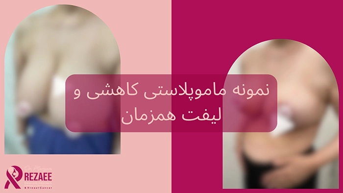 نمونه ماموپلاستی کاهشی