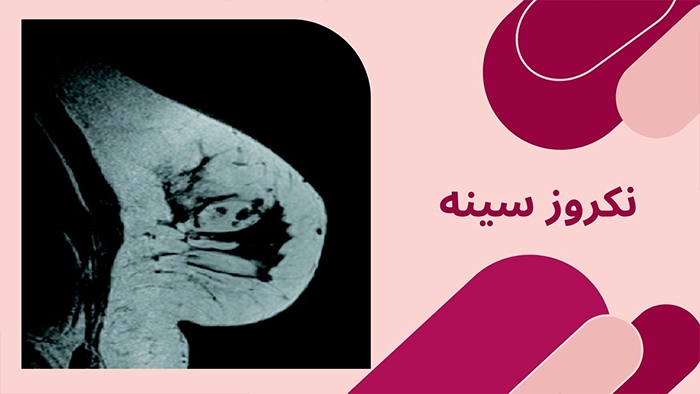 نکروز سینه بعد از جراحی سینه