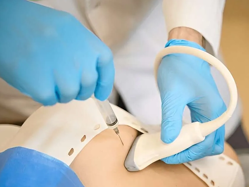 تخلیه کیست پستان