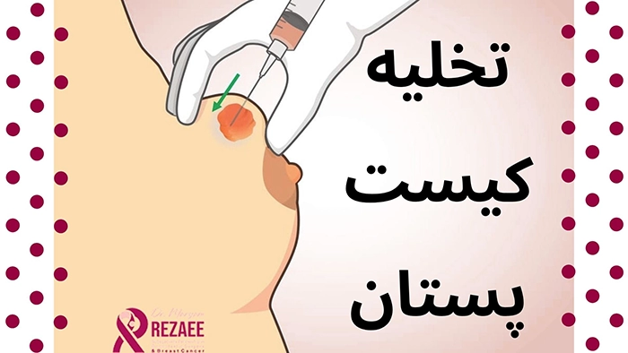 تخلیه کیست پستان