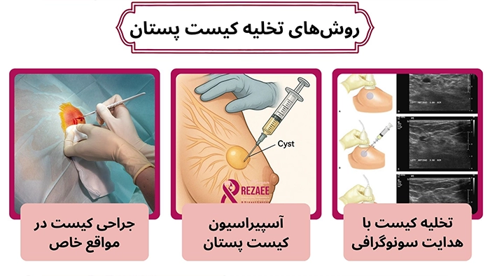 بهترین روش تخلیه کیست پستان