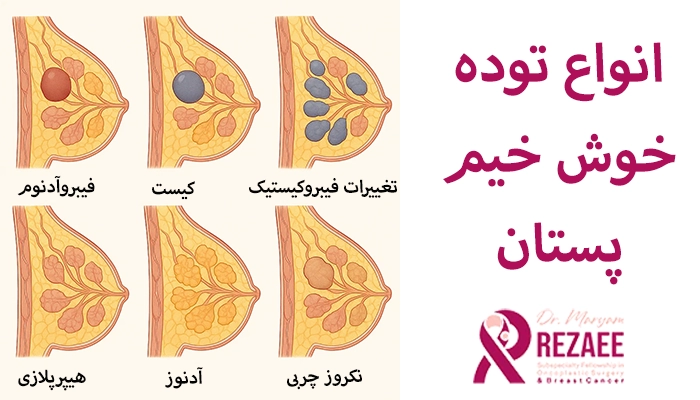 انواع توده خوش خیم پستان