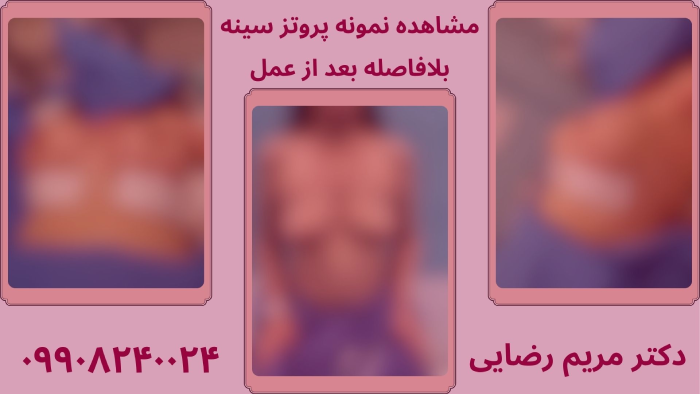 نمونه پروتز سینه