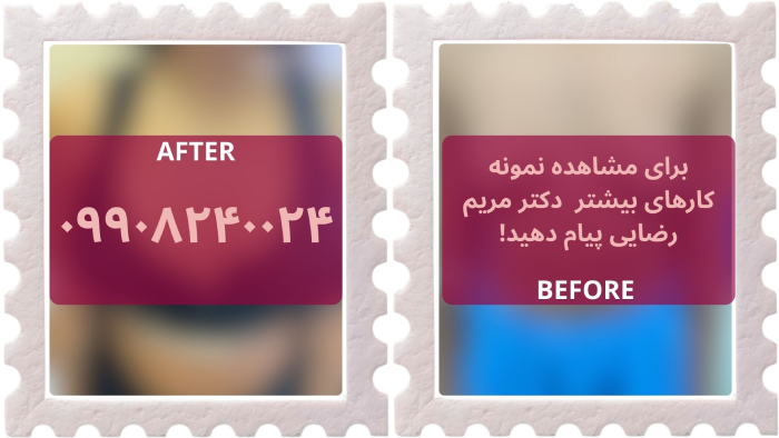 تصویر قبل و بعد پروتز سینه