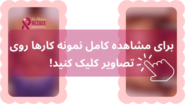 عکس پروتز سینه