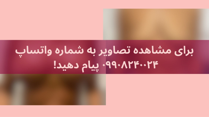 نمونه سایز پروتز سینه