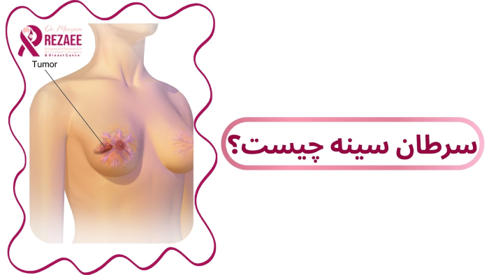 سرطان سینه
