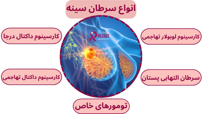 انواع سرطان پستان