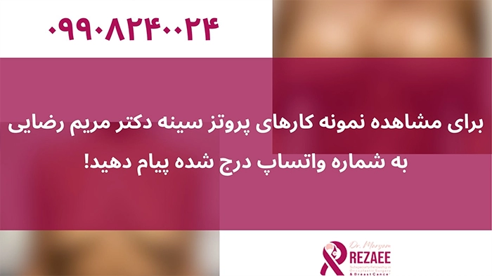 نمونه کار پروتز سینه