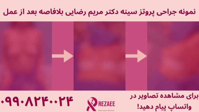 نمونه پروتز سینه