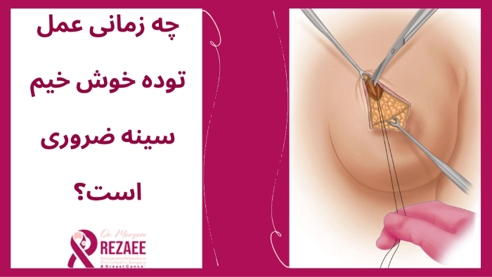 عمل توده سینه