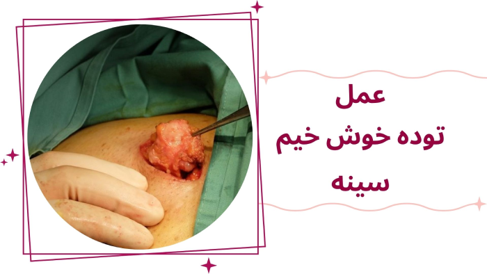 جراحی توده خوش خیم پستان