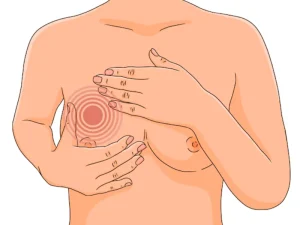 درمان توده خوش خیم سینه