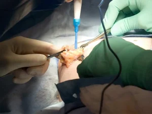 عوارض بعد از عمل سرطان سینه