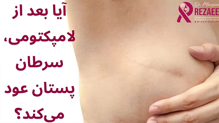 عود سرطان سینه بعد از لامپکتومی